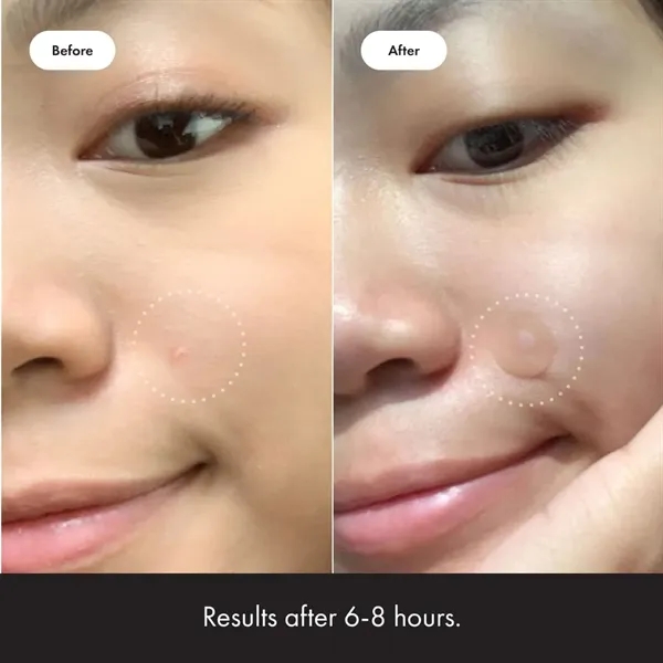 Invisible Acne Patch - Fast & Gentle Treatment - Invisible Acne Patch - Fast & Gentle Treatment - Image 4 of 8