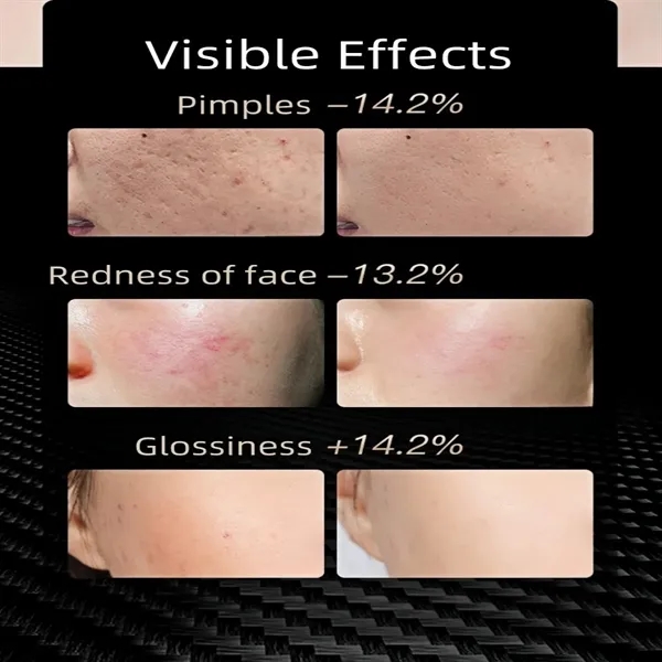 Red Light Therapy Mask For Youthful Glowing Skin At Home - Red Light Therapy Mask For Youthful Glowing Skin At Home - Image 3 of 4